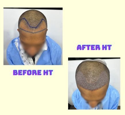 hair-transplant-in-coimbatore